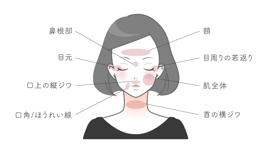 コラーゲン製剤で施術可能な部位