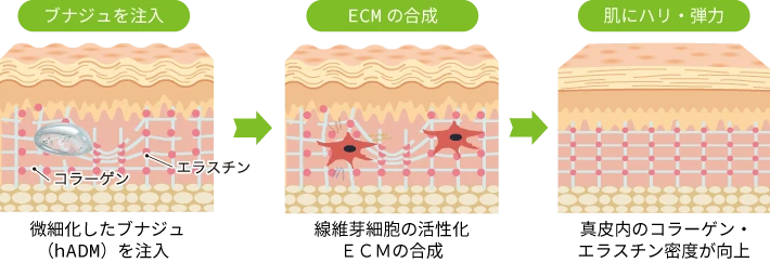 ブナジュのメカニズム