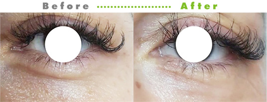 プルリアルシルク症例１